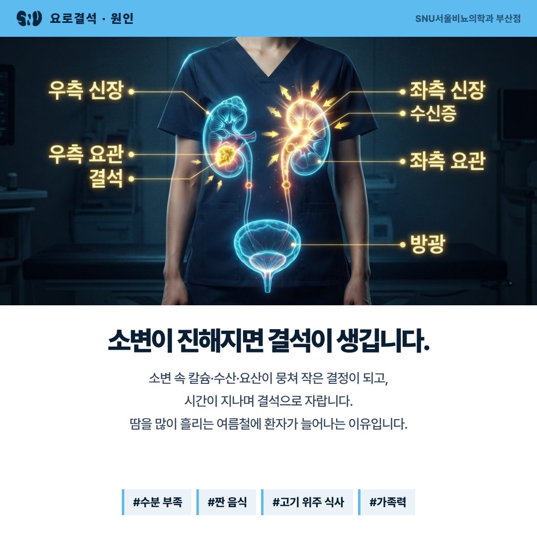 소변이 진해지면 결석이 생기는 원리